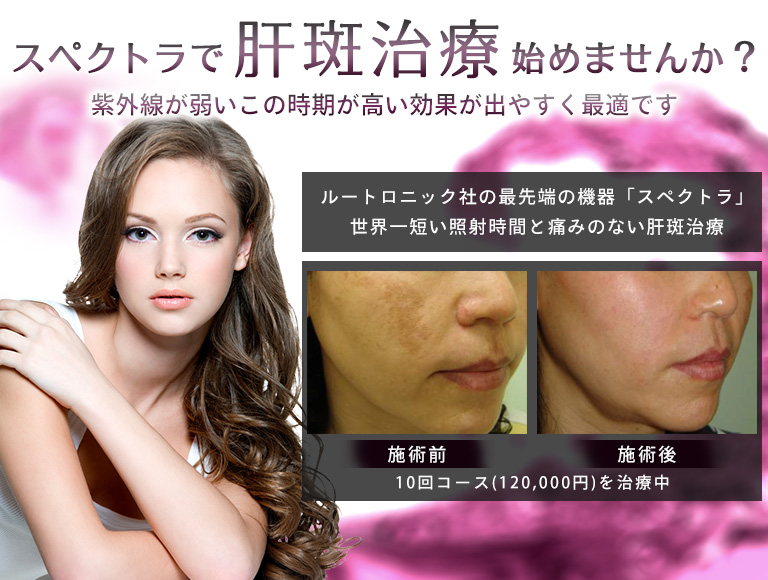 スペクトラで肝斑治療