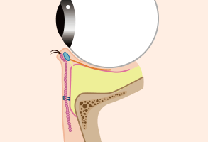 下眼瞼形成/施術イメージ3