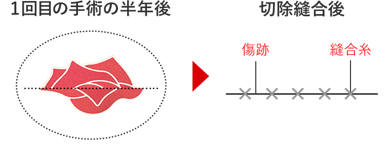 施術2回目-1