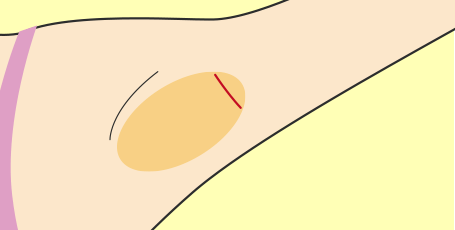 わきが（ワキガ・腋臭症）皮弁法